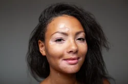 African woman with vitiligo on face smiling