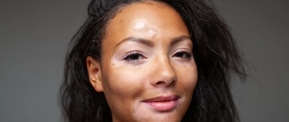 African woman with vitiligo on face smiling