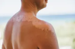 Long-term effects sun exposure skin Long-term effects sun exposure skin