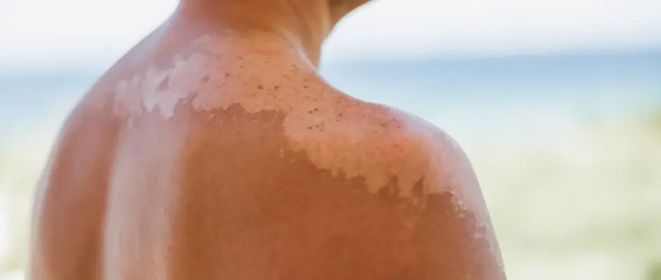 Long-term effects sun exposure skin